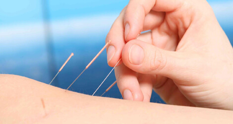 Acupuncture